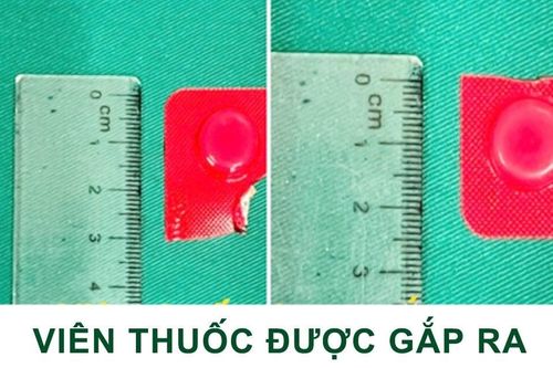 Uống cả nắm thuốc, sơ ý nuốt luôn viên còn nguyên vỏ cứng