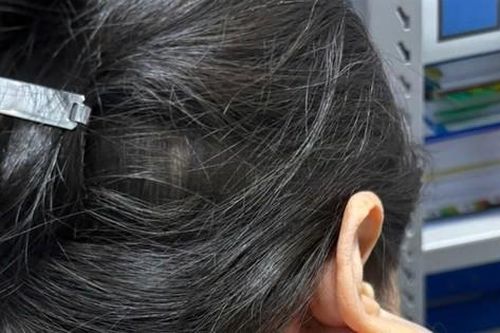 Suýt mất mạng vì u khổng lồ trên mặt