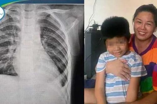 Em bé 6 tuổi bị lạc thận lên lồng ngực