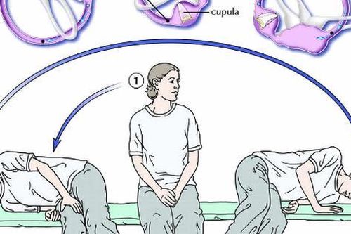 Bài tập cho người chóng mặt kịch phát lành tính