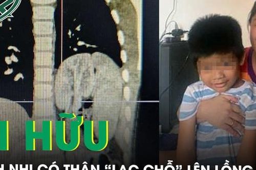 Hi hữu bệnh nhi có thận 'lạc chỗ' lên lồng ngực