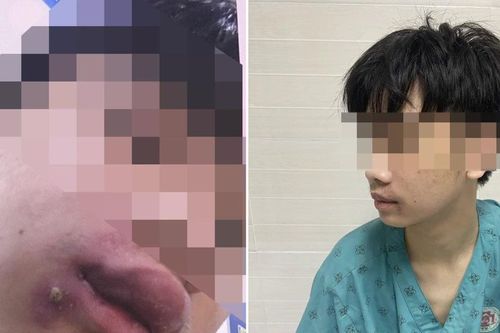 Nhiễm khuẩn từ vết thương nhỏ