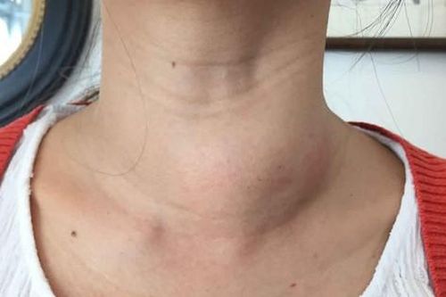 4 lưu ý để phục hồi sức khỏe sau khi mổ bướu cổ