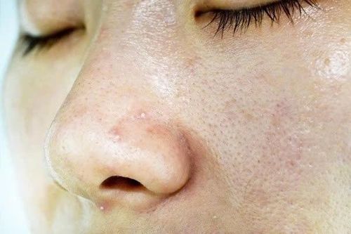 Chăm da dầu không quá khó nếu biết những lưu ý này