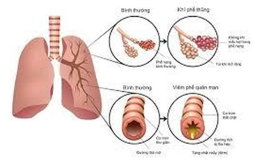Bệnh phổi tắc nghẽn mãn tính có chữa dứt điểm được không?