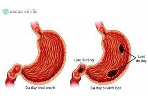 Đi cầu phân đen là bệnh gì?