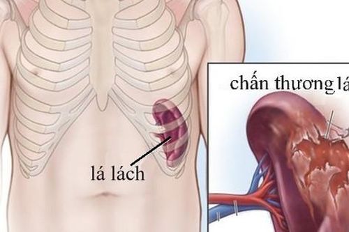 Thuốc và các phương pháp điều trị chấn thương lách