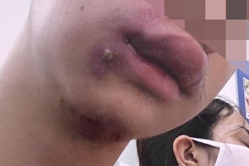 Vì sao chỉ nặn một nốt mụn nhỏ cũng có thể đi cấp cứu