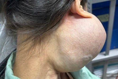 Người phụ nữ suýt mất mạng vì khối u 'khổng lồ' trên mặt