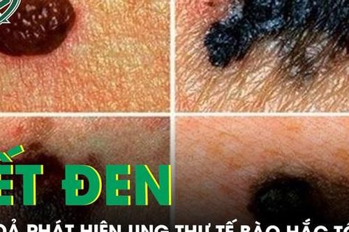 Chủ quan vết đen trên da, đi khám tá hỏa phát hiện ung thư tế bào hắc tố