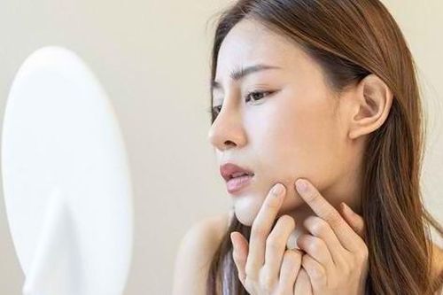 Cách chăm sóc da ngăn ngừa mụn tái phát