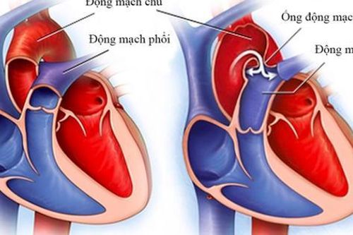 Vụ tử vong sau thay van động mạch chủ qua da: BV Bạch Mai đang làm rõ 3 bác sĩ tham gia