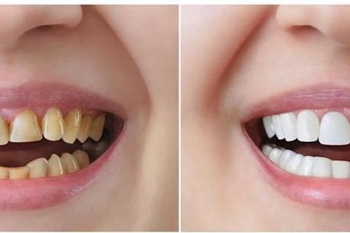 Ưu nhược điểm của bọc răng sứ là gì?