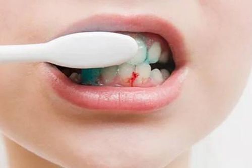 Trẻ em bị viêm nướu, chảy máu chân răng do đâu?
