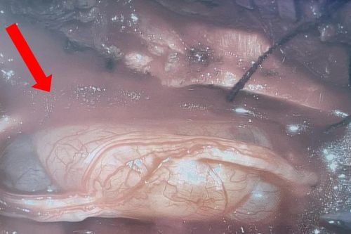 U tủy sống khiến cô gái 26 tuổi mất cảm giác hai chân