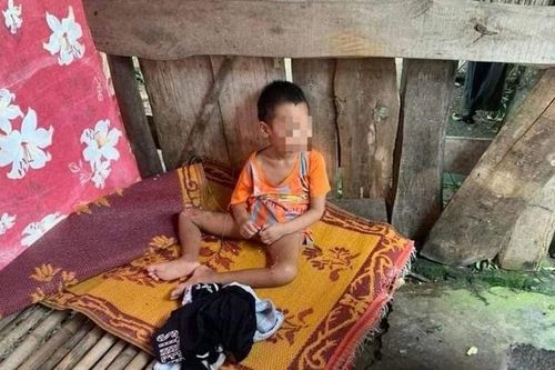 Nghệ An: Đứa trẻ bị 'bỏ rơi' dẫn đến hoại tử xương cụt, lở loét phần đùi