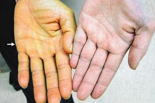 Bệnh nhân ngộ độc nặng, tan máu cấp khi uống nước lá lộc mại chữa táo bón