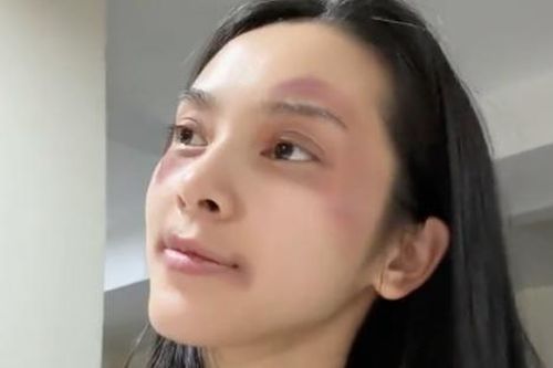 Quỳnh Lương tố bị bạn trai thiếu gia 'tác động vật lý', mắt bầm tím?