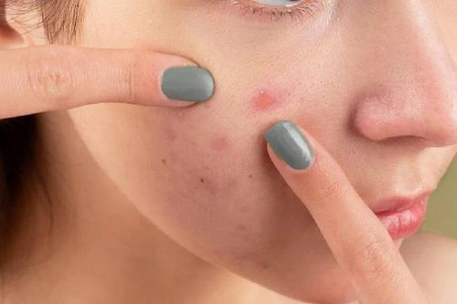 Trị mụn bằng tỏi: Ăn sống hay bôi lên da?
