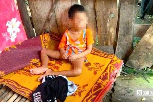 Hoàn cảnh thương tâm của cháu bé 5 tuổi gãy chân, bị gia đình 'bỏ mặc' ở lán sau nhà