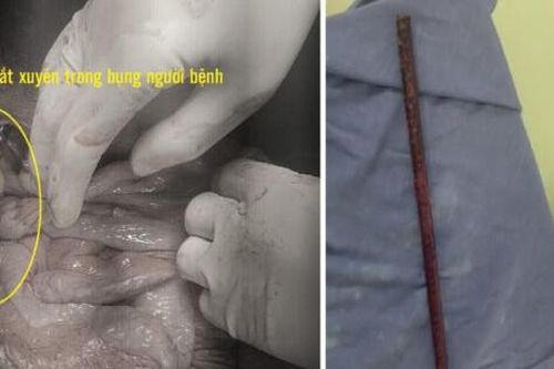 Bỏ qua thủ tục hành chính, cứu thanh niên bị thanh sắt đâm xuyên bụng