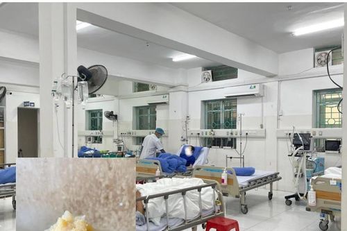Bệnh nhân ngừng thở do hóc bánh nếp