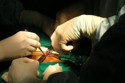 Cứu sống trẻ sơ sinh 4h tuổi bị vỡ ruột từ trong bụng mẹ