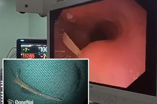 Một phụ nữ ở Biên Hòa bị xương cá dài 14mm đâm suýt trúng động mạch cảnh