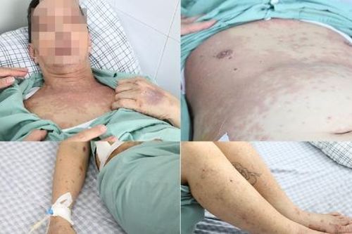 Dị ứng khắp người do tự ý uống thuốc chữa đau khớp