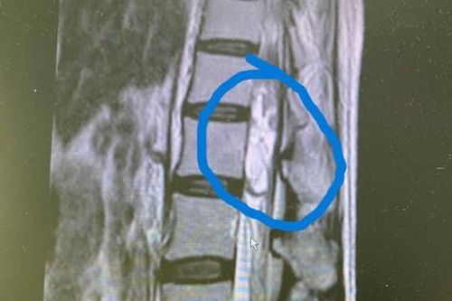 Bệnh nhân u tủy sống thoát khỏi nguy cơ liệt 2 chân nhờ bóc tách khối u