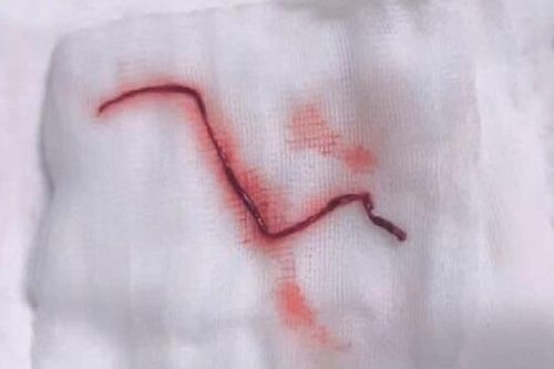 Lấy được cục máu đông gây đột quỵ dài chưa từng thấy