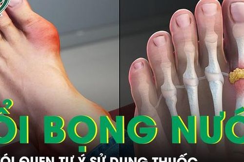 Sốt cao, nổi nhiều bọng nước rải rác do thói quen tự ý sử dụng thuốc