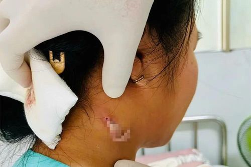 Nóng: Đồng Nai ghi nhận ca bệnh 'vi khuẩn ăn thịt người' Whitmore đầu tiên