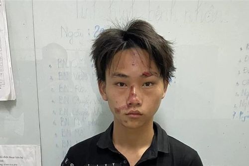 Nam thanh niên không đội mũ bảo hiểm, tông Trưởng Công an xã chấn thương sọ não