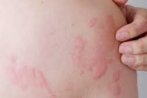 Làm gì để bớt ngứa do nổi mề đay?