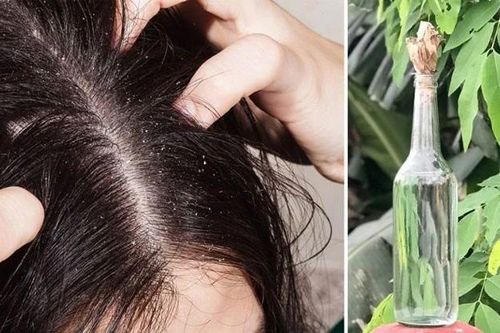 Bỏng giác mạc do dùng rượu ngâm hạt na để ủ chấy