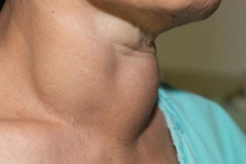 Doanh nghiệp phản đối bổ sung vi chất dinh dưỡng vào muối, bột mì: Các nhà khoa học nói gì?