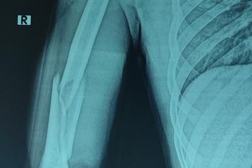 Thanh niên 21 tuổi ở Nghệ An gãy cánh tay khi chơi vật tay cùng bạn