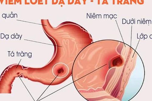 Nhận biết và phòng tránh viêm loét dạ dày tá tràng