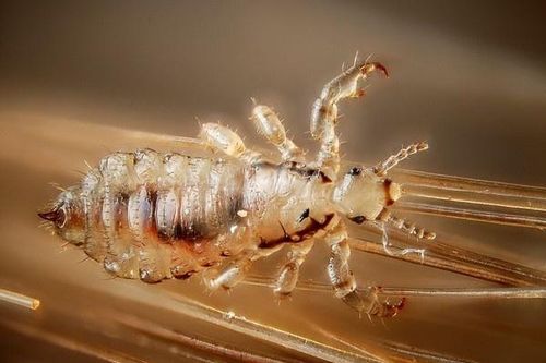 Mẹ con cùng nhập viện vì dùng cách nguy hiểm để diệt chấy