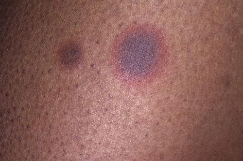 Một số loại phát ban da do thuốc thường gặp