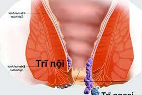 Bị trĩ nhẹ, thay đổi lối sống có tự khỏi không?