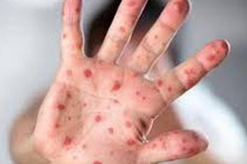 Bị sởi tắm lá gì?