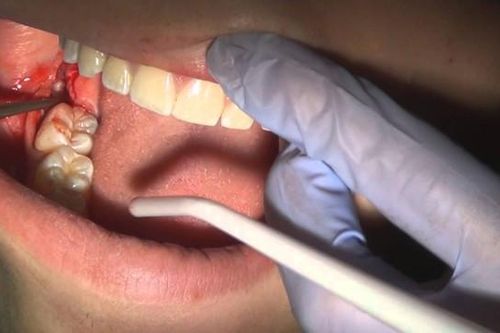 Người đàn ông tử vong sau 13 ngày nhổ răng vì thủ thuật gây tranh cãi