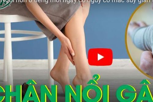 Ngồi hơn 6 tiếng mỗi ngày có nguy cơ mắc suy giãn tĩnh mạch