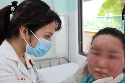 Thành phố Hồ Chí Minh: Cô gái nhập viện sau khi peel da tại nhà