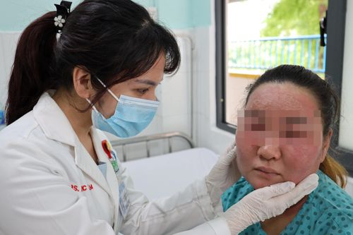 Mặt mũi sưng híp sau khi tự dùng hóa chất lột da