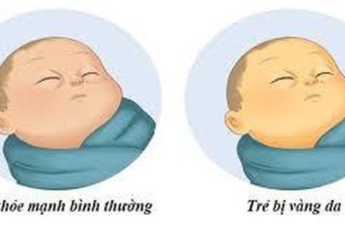 Làm sao để hết vàng da ở trẻ sơ sinh?