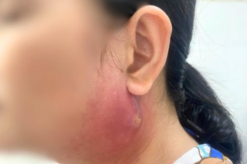 Người phụ nữ phải vào phòng phẫu thuật chỉ vì nốt mụn nhọt