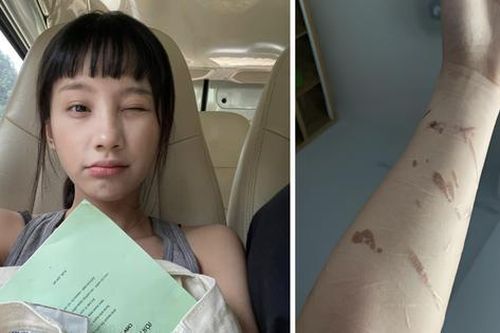 Nữ chính 'Đi giữa trời rực rỡ' nói gì về sẹo chằng chịt trên tay?